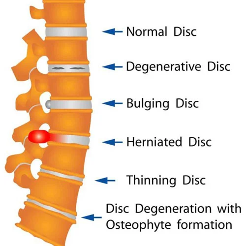 Slip Disc treatment in Dehradun