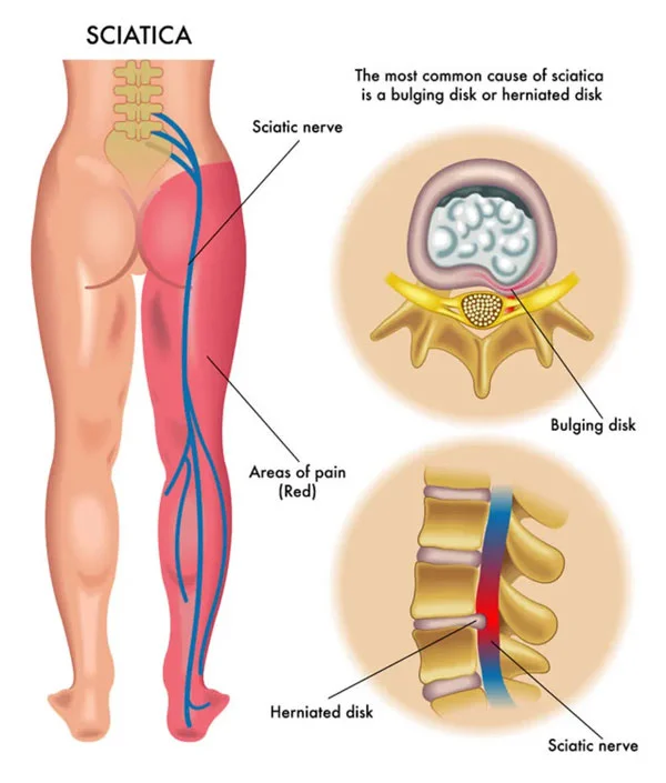 Cerebral palsy treatment in India